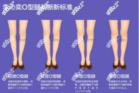 李沁奕O型腿靠谱吗？