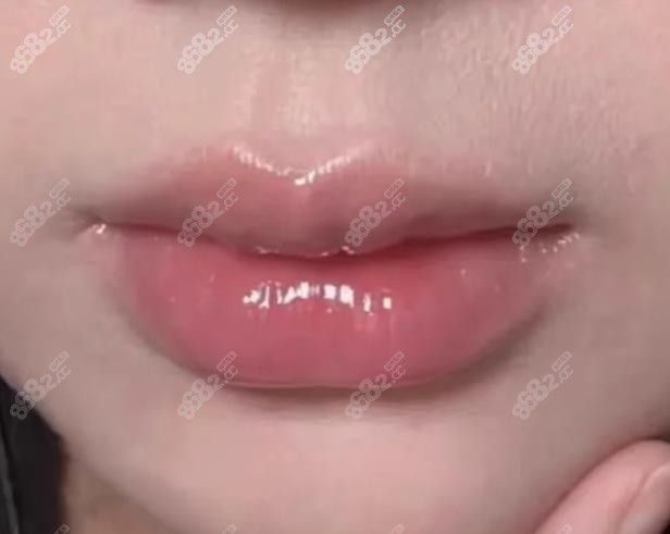 成都丰唇哪家医院做得好?美莱/画美/华美审美在线实例丰富