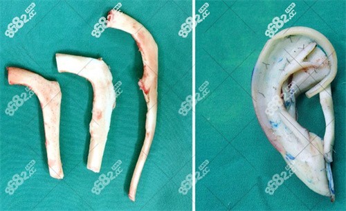毋巨龙医生做耳再造手术
