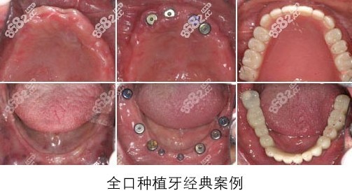 点种满口牙齿的病例