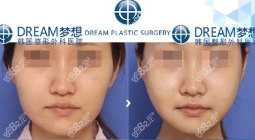 韩国梦想下颌角整形前后对比图