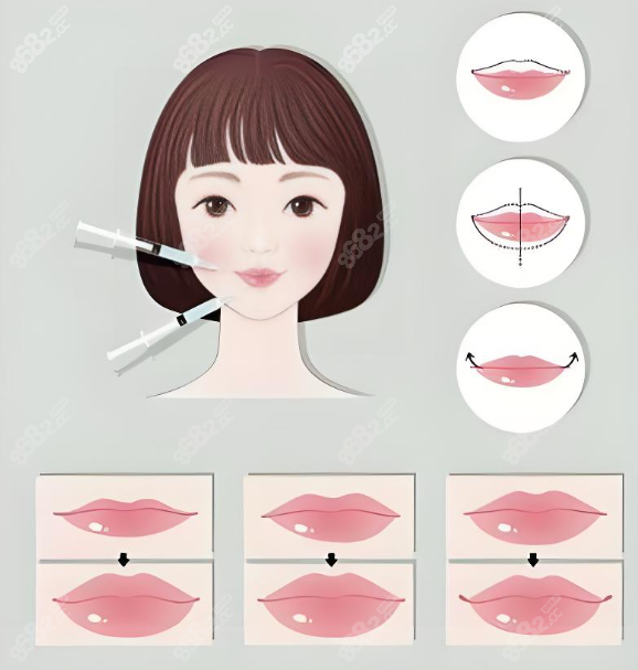 玻尿酸丰唇价格