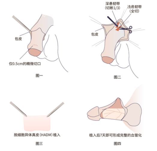 李世荣做阴茎再造手术过程