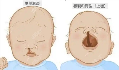 余文林医生在唇裂修复方面有哪些特点？