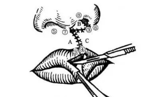 唇裂修复选广州高尚！余文林亲诊+技术可靠 患者就诊更安心