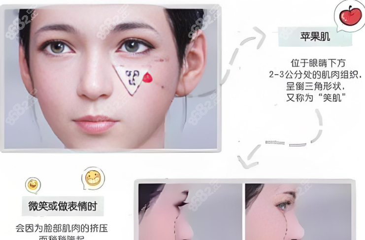 玻尿酸丰苹果肌示意图