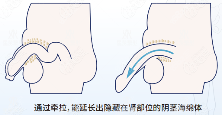 李世荣男性生殖器整形范例