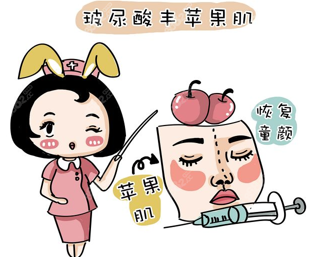 玻尿酸丰苹果肌