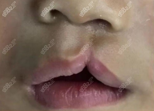 余文林医生在唇裂修复方面有哪些特点？