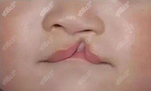 为什么唇裂修复选广州高尚？