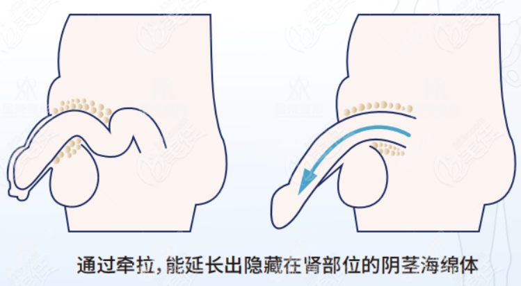 李世荣手术价格费用有人知道吗