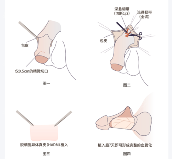 李世榮做男性生殖器延長增粗手術(shù)費用
