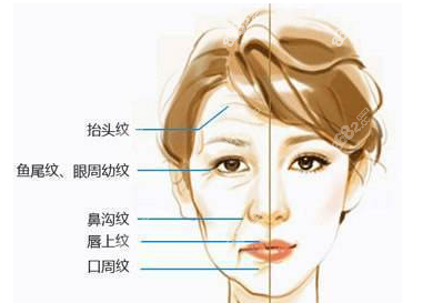 面部筋膜提升有用適應(yīng)這些人群（m.8682.cc）