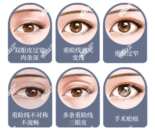 南宁双眼皮修复哪家医院好