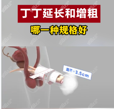 李世榮做男性生殖器延長增粗手術(shù)費用