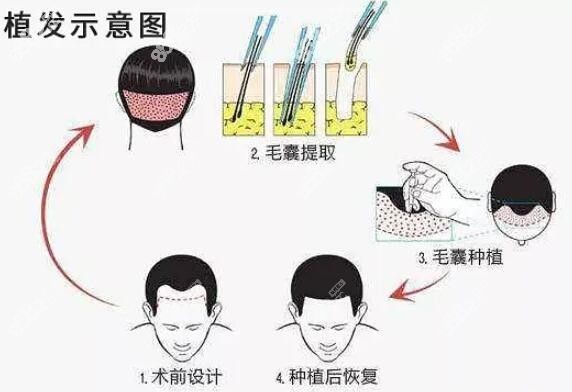 唐山脱发做植发哪家医院好