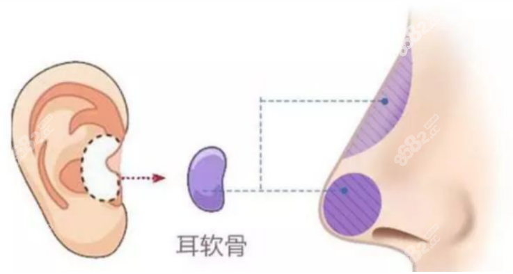成都西区整形医院哪个医生做鼻子好