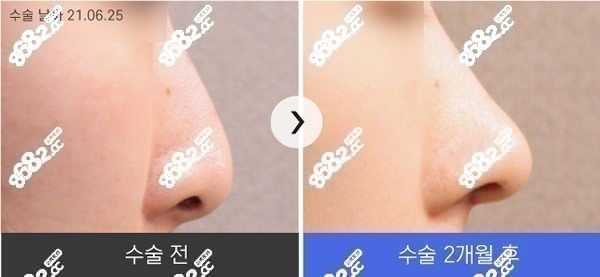 韩国李丙玟院长鼻修复2个月对比图片