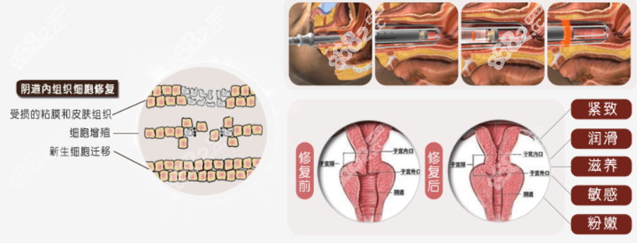 韩国如妍妇科激光缩阴前后对比 韩国如妍妇科激光缩阴前后对比