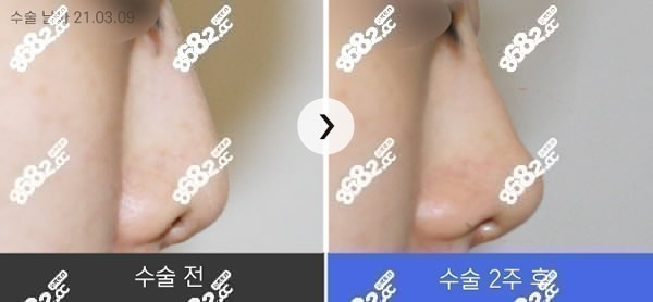 韩国鼻修复医生李丙玟修复鼻子2周（半个月）照片