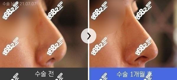 韩国李炳问医生真人鼻修复1个月前后对比图片分享