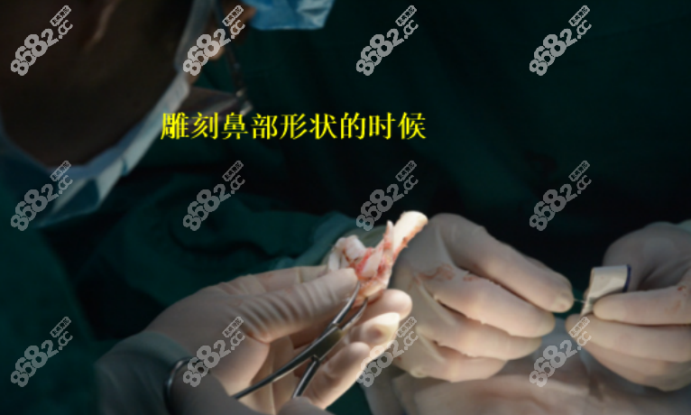 邓东伟医生做隆鼻的样子