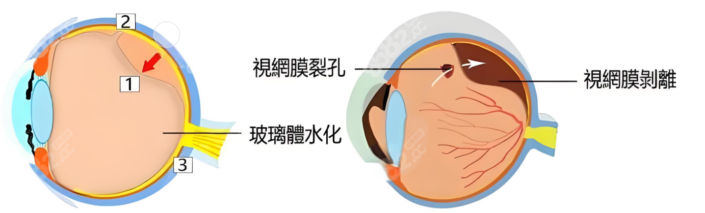 段安麗醫(yī)生擅長后鞏膜加固術(shù)