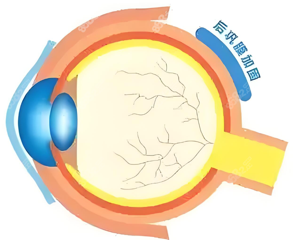 段安麗后鞏膜加固技術(shù)好