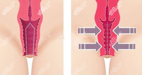 韩国缩阴手术前后对比 韩国缩阴手术前后对比