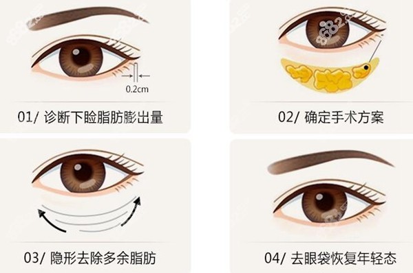 广州健丽不开刀去眼袋过程
