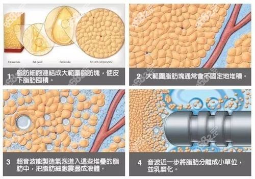威塑吸脂第三代3.0版m.8682.cc