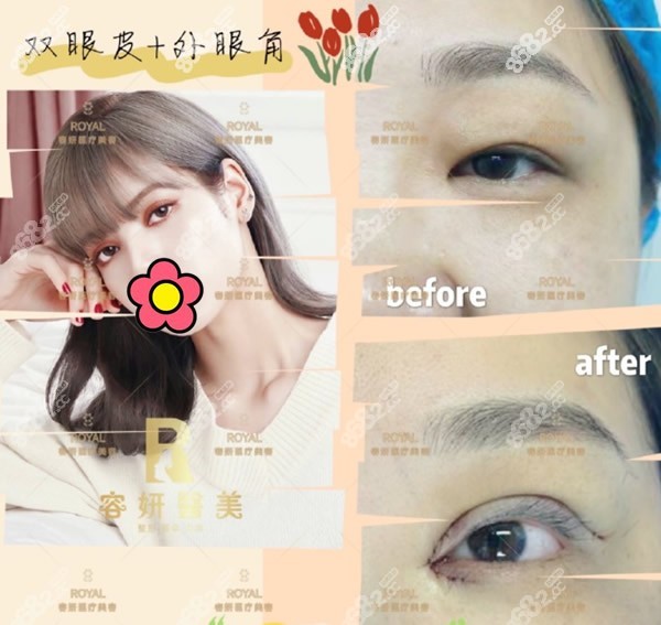 上海柴云医生修复双眼皮的技术怎么样
