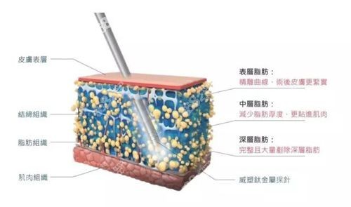 威塑吸脂第二代2.2版www.ekelt.cn