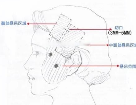 小切口除皱切口位置