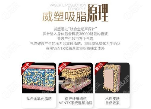 威塑吸脂有幾代