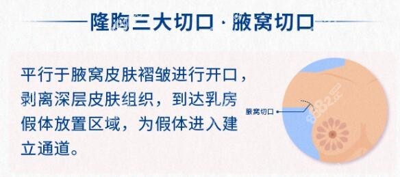 假体隆胸腋下切口图片8682.cc