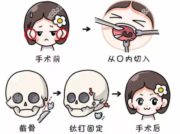 广州磨骨好价格便宜的医院有哪些