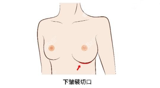 丰胸选择下皱襞切口不留疤恢复还比较快