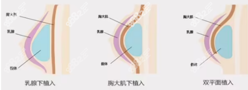 <!--<i data=20240705-sp></i>-->醫(yī)生隆胸