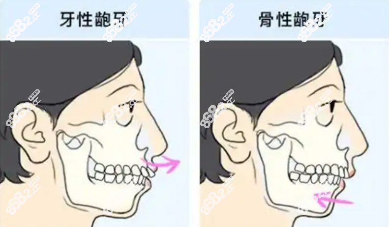 骨性牙性凸嘴