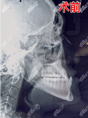 地包天術(shù)前照片