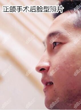 正頜手術(shù)后臉型圖片