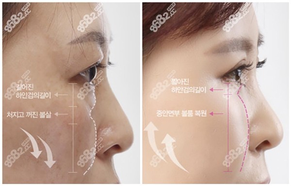 大眼睛做眼部修復(fù)的病例圖