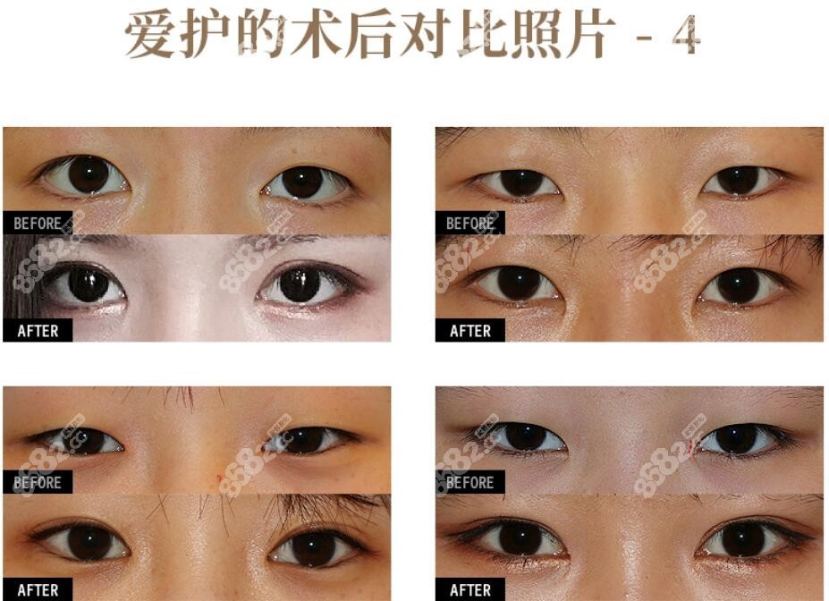 愛護(hù)整形的雙眼皮術(shù)后對比照片