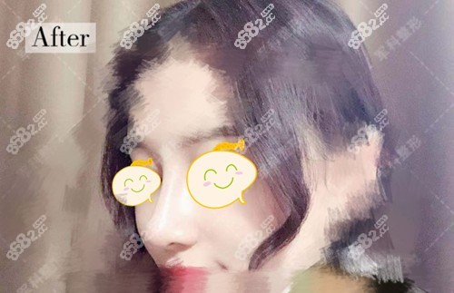 重慶軍科整形<!--<i data=20240705-sp></i>-->院長做隆鼻術(shù)后1個月