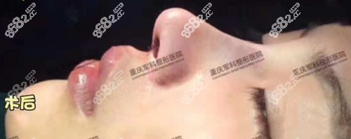 重慶軍科整形<!--<i data=20240705-sp></i>-->院長做隆鼻術(shù)后即刻