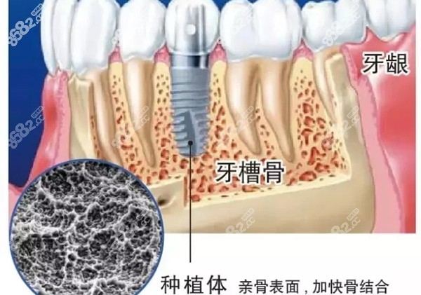 种植体在牙槽骨内的图