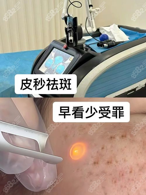 广州皮秒祛斑好的医院排名:曙光|华美|艺星皮秒激光祛斑好