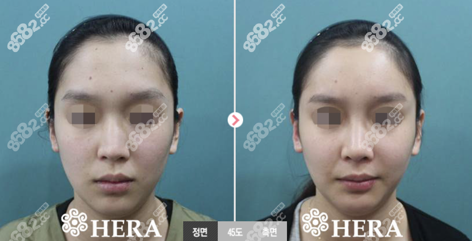 韩国赫拉整形李丙玟院长隆鼻修复例子