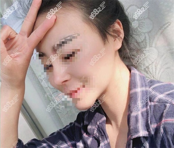 上海华美隆鼻实例2